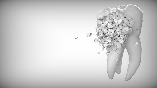 Implantes dentales y las ventajas de llevarlos