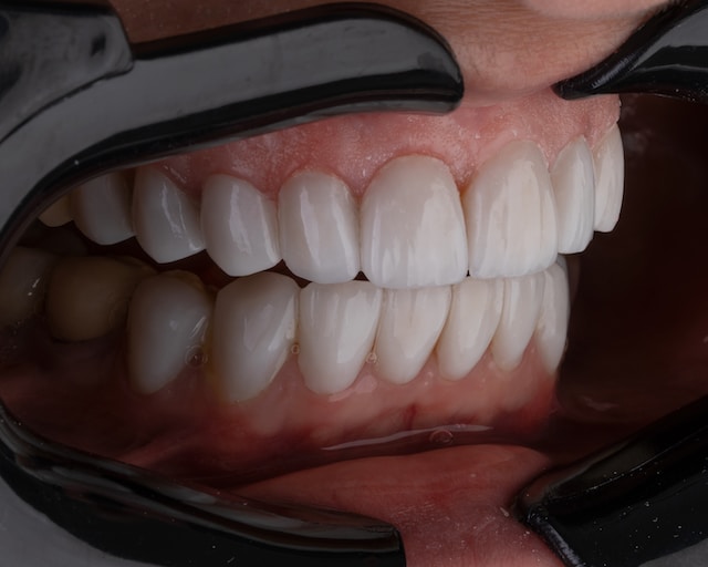 Tratamientos para el bruxismo: cómo dejar de apretar y rechinar los dientes