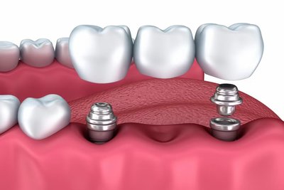 Implantes y dentaduras postizas